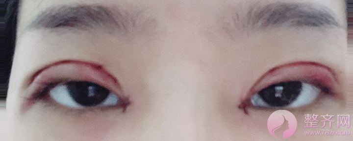 深圳眼部手术案例95天