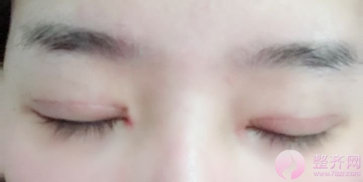 深圳眼部手术案例95天
