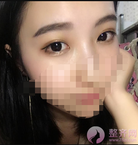 深圳眼部手术案例95天