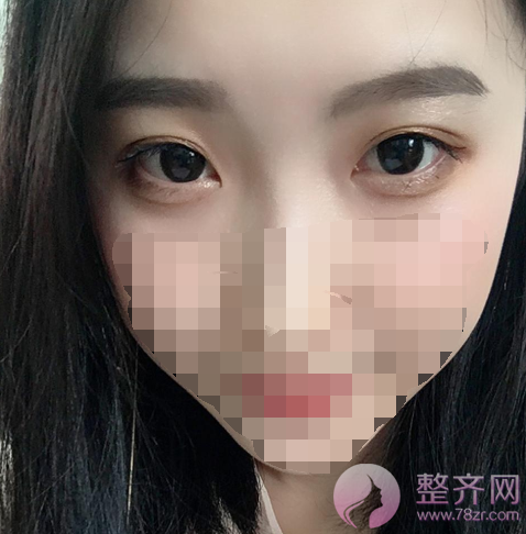 深圳眼部手术案例95天