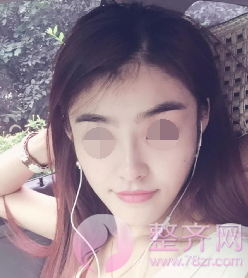 西安自体脂肪填充面部术后73天案例