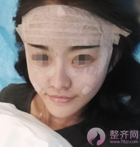 西安自体脂肪填充面部术后73天案例