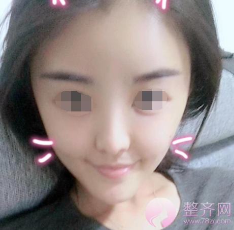 西安自体脂肪填充面部术后73天案例