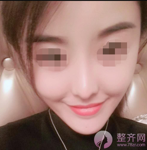 西安自体脂肪填充面部术后73天案例