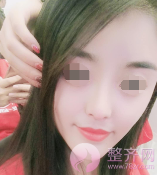 西安自体脂肪填充面部术后73天案例