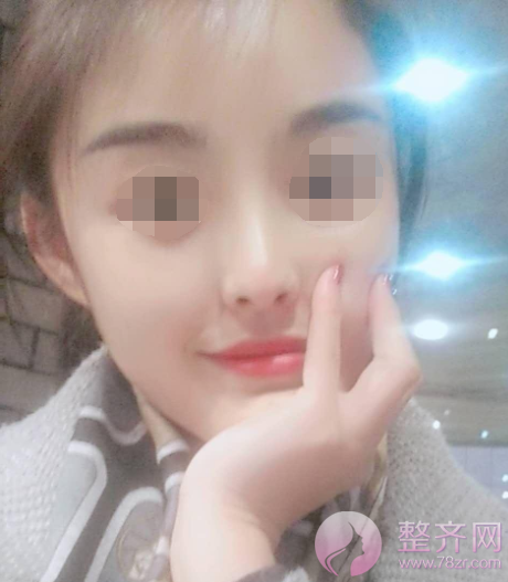 西安自体脂肪填充面部术后73天案例