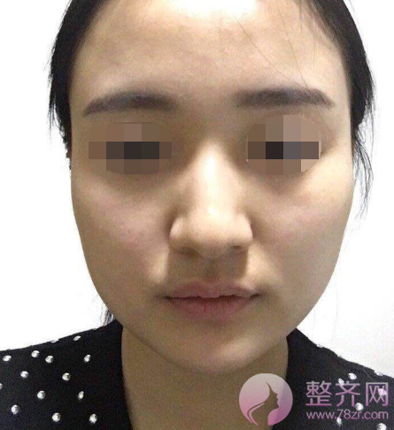 杭州自体脂肪全脸填充术后102天