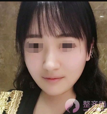 杭州自体脂肪全脸填充术后102天