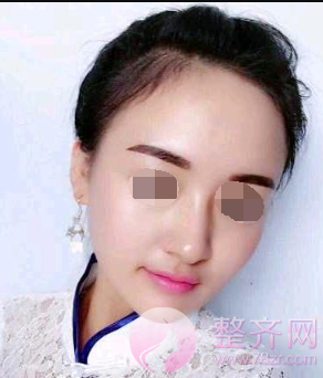 杭州自体脂肪全脸填充术后102天