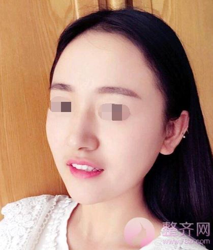 杭州自体脂肪全脸填充术后102天