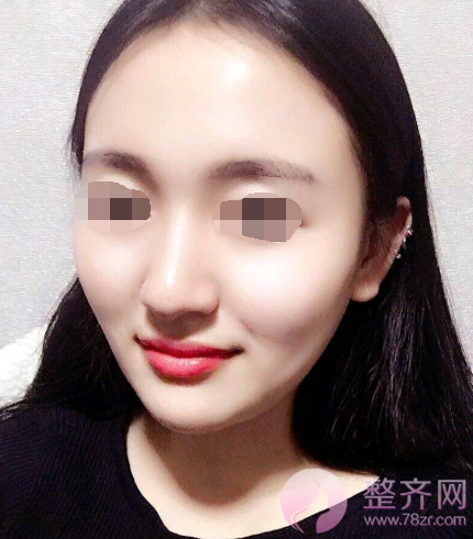 杭州自体脂肪全脸填充术后102天