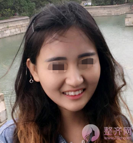 杭州自体脂肪全脸填充术后102天
