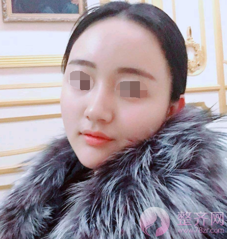 杭州自体脂肪全脸填充术后102天