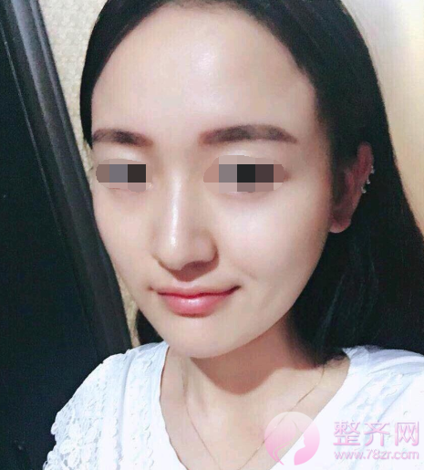 杭州自体脂肪全脸填充术后102天