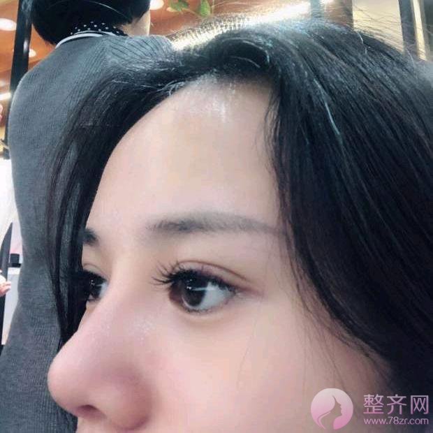 成都膨体隆鼻案例术后58天