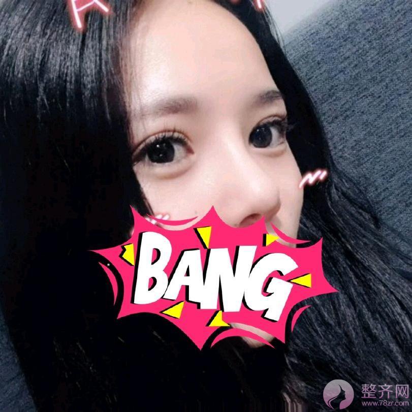 成都膨体隆鼻案例术后58天