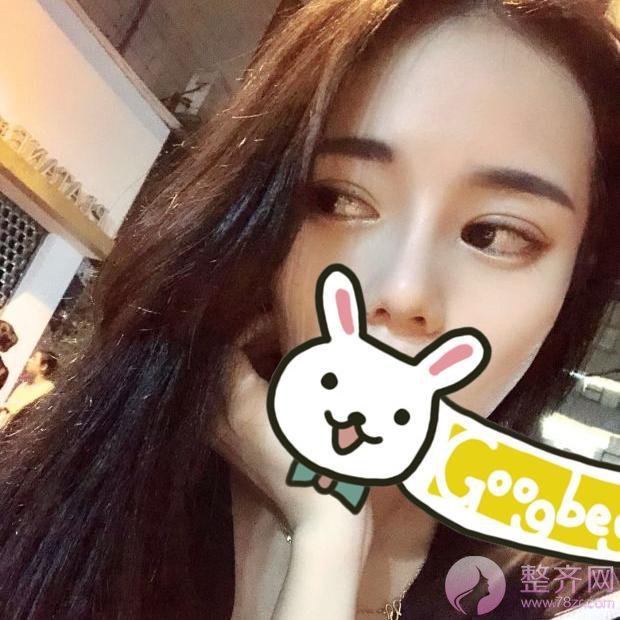 成都膨体隆鼻案例术后58天