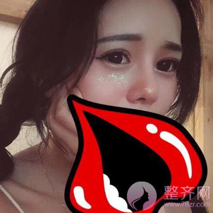成都膨体隆鼻案例术后58天