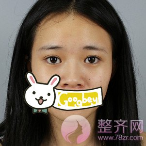 成都膨体隆鼻案例术后58天