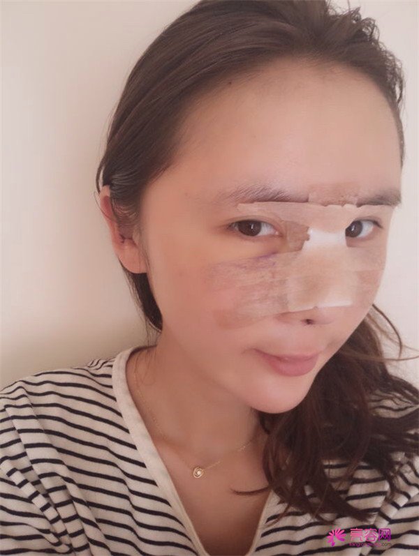 来分享我的鼻部手术案例啦~~~这个世界上没有丑女人,只有懒女人哈哈!来给个意见看看我做的怎么样?