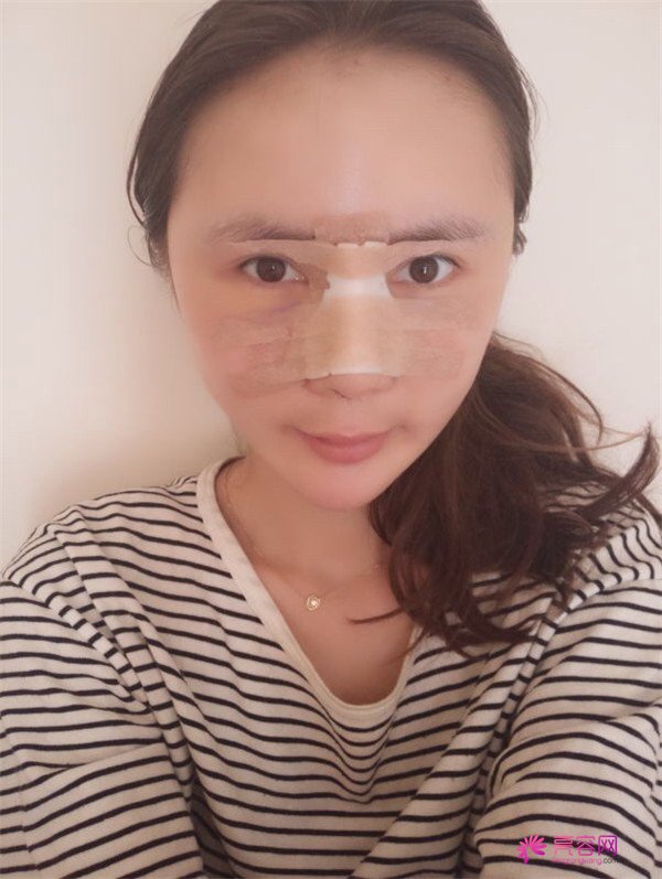 来分享我的鼻部手术案例啦~~~这个世界上没有丑女人,只有懒女人哈哈!来给个意见看看我做的怎么样?
