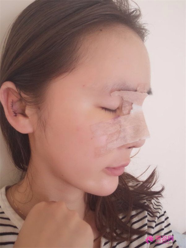 来分享我的鼻部手术案例啦~~~这个世界上没有丑女人,只有懒女人哈哈!来给个意见看看我做的怎么样?