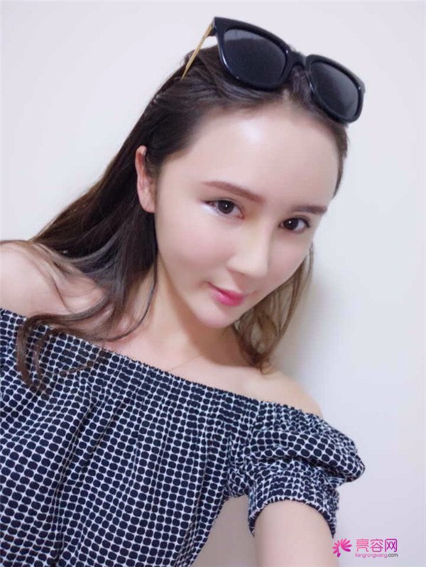 来分享我的鼻部手术案例啦~~~这个世界上没有丑女人,只有懒女人哈哈!来给个意见看看我做的怎么样?