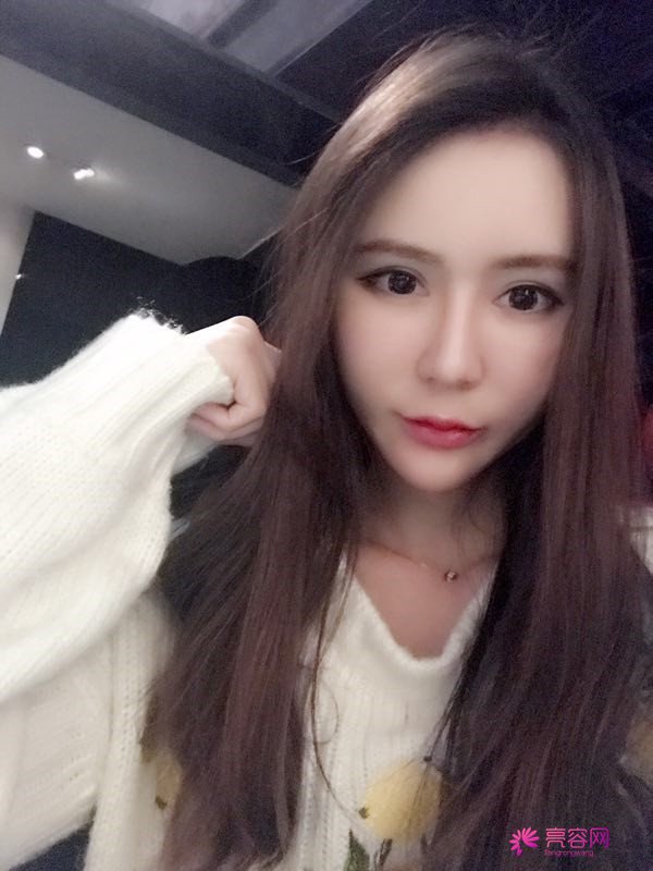 来分享我的鼻部手术案例啦~~~这个世界上没有丑女人,只有懒女人哈哈!来给个意见看看我做的怎么样?