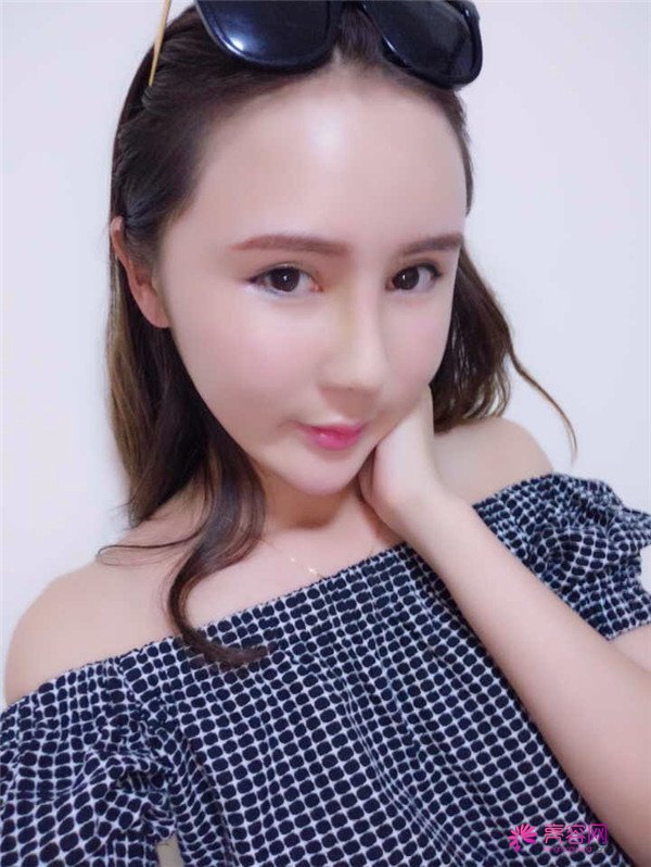 来分享我的鼻部手术案例啦~~~这个世界上没有丑女人,只有懒女人哈哈!来给个意见看看我做的怎么样?