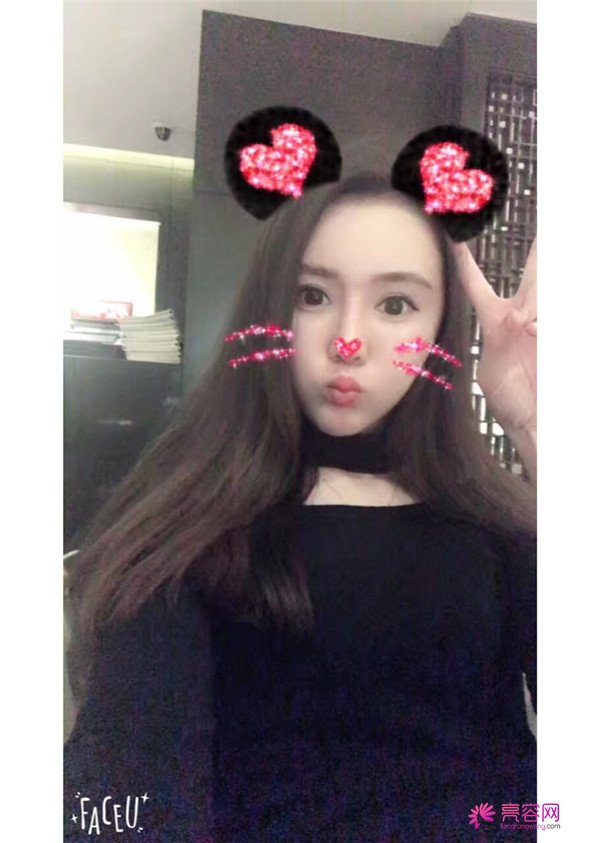 来分享我的鼻部手术案例啦~~~这个世界上没有丑女人,只有懒女人哈哈!来给个意见看看我做的怎么样?