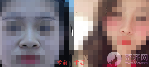 厦门鼻部手术案例术后58天