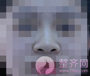 厦门鼻部手术案例术后58天