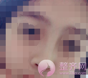 厦门鼻部手术案例术后58天