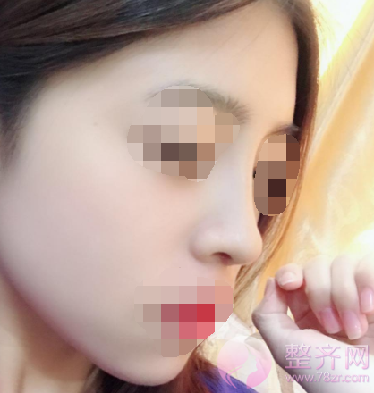 厦门鼻部手术案例术后58天