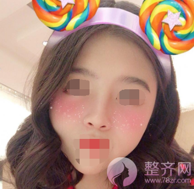 厦门鼻部手术案例术后58天