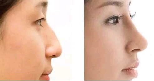 如何来判断自己隆的鼻子是否成功了呢?