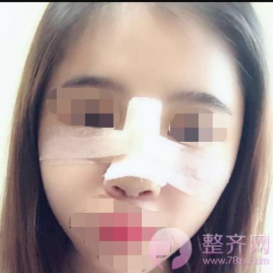 隆鼻手术后如何做才能让鼻子较好的果?