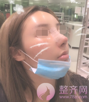 隆鼻手术后如何做才能让鼻子较好的果?