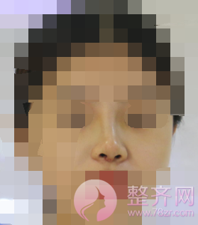 隆鼻手术后如何做才能让鼻子较好的果?