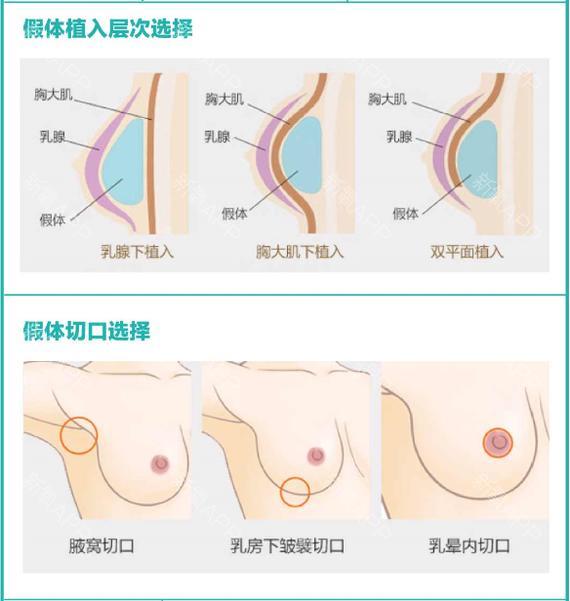假体隆胸的误区,你造吗?