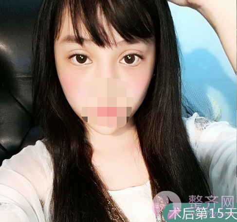 上海眼部手术案例,双眼皮带来的魅力