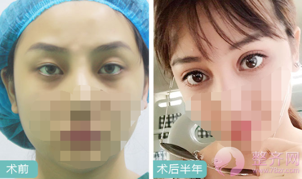上海眼部手术案例,双眼皮带来的魅力