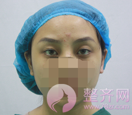 上海眼部手术案例,双眼皮带来的魅力
