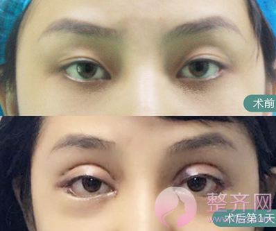 上海眼部手术案例,双眼皮带来的魅力