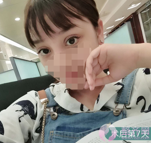 上海眼部手术案例,双眼皮带来的魅力