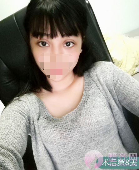 上海眼部手术案例,双眼皮带来的魅力