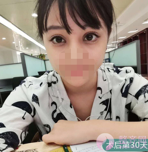 上海眼部手术案例,双眼皮带来的魅力