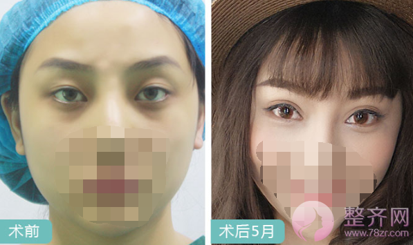 上海眼部手术案例,双眼皮带来的魅力