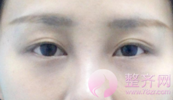 长沙全切双眼皮术后78天日记