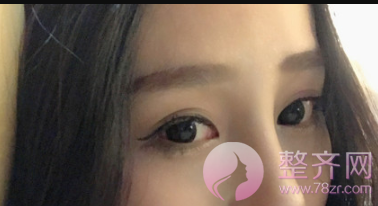 长沙全切双眼皮术后78天日记